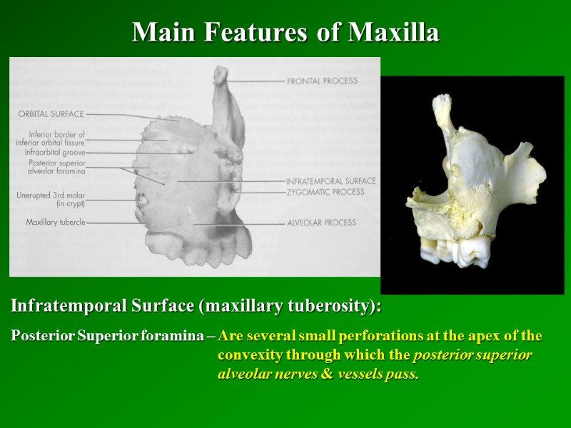 Main Features of Maxilla   Infratemporal Surface (maxillary tuberosity): Posterior Superior foramina –